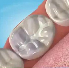 Selladores Dentales