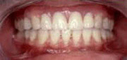 After Dental Bridge