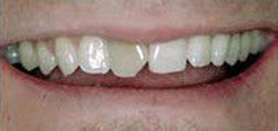 Before Dental Crown