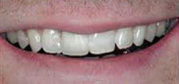 After Dental Crown