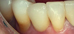 After Dental Implant