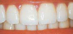 After Gum Reshaping