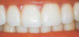 Lakeview Teeth Whitening