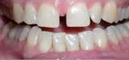 Before Invisalign Orthodontics