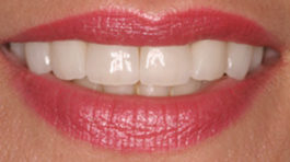 Teeth Whitening Lakeview