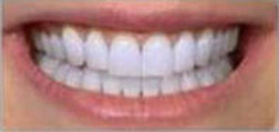 Teeth Whitening Lakeview
