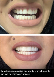 Before & After Smile Makeover