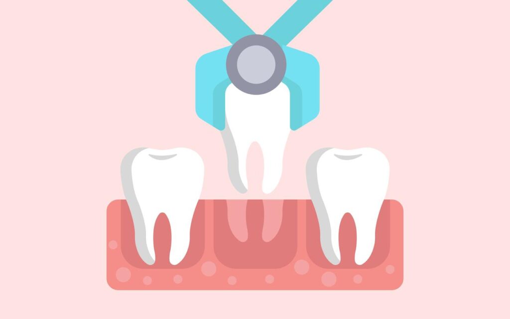 Tooth extraction illustration.