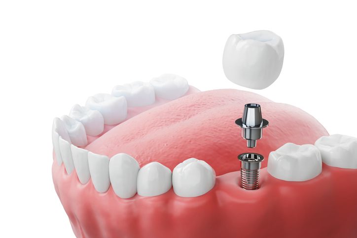 Image of a dental implant showing the implant that has been placed in the gum, the abutment that will be placed into the implant, and the crown or artificial tooth that will be attached to the abutment. 