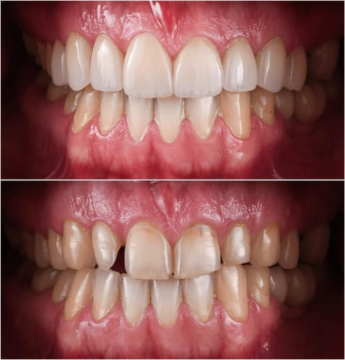 Porcelain Dental Crowns Before and After
