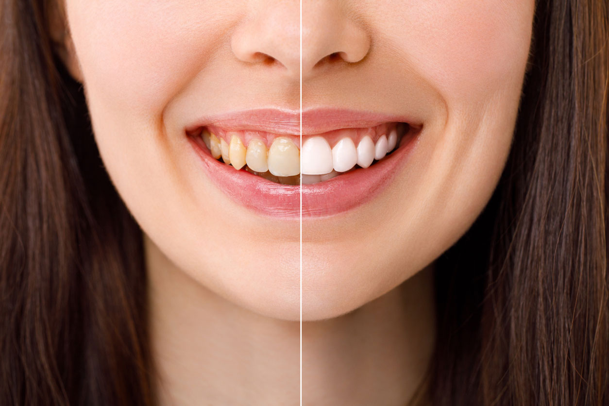 Before and after of tooth whitening process